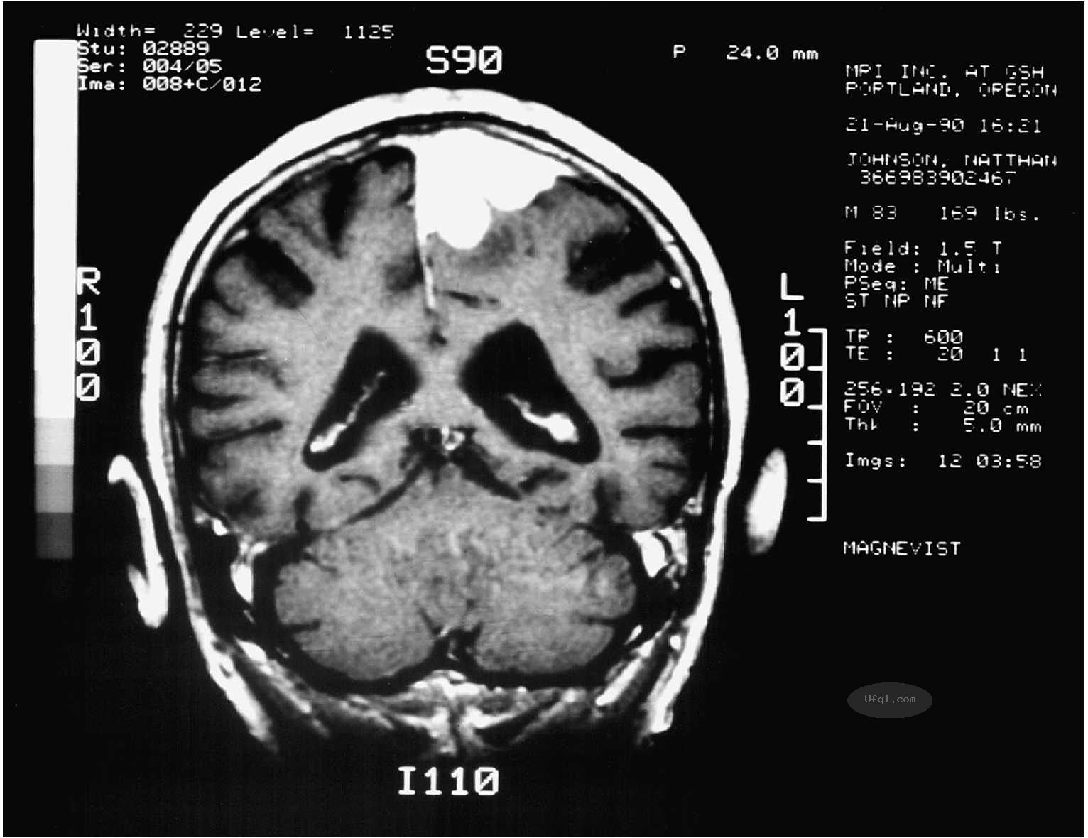 津巴多普通心理学 Psychology: Core Concepts-6: 第二章 生物心理学,神经科学与人类天性-20: 脑损伤